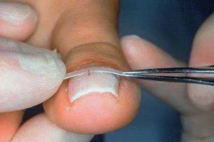 Nagelregulatie-foto-3-300x200