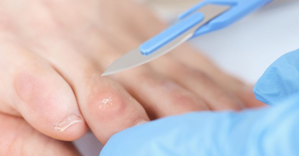 Likdoorn-verwijderen-door-pedicure-1024x536-1